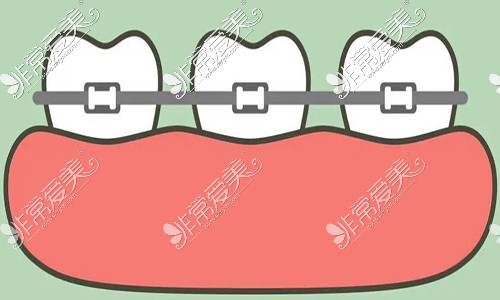 戴牙套过程分为几个阶段？你想知道的这里都有！