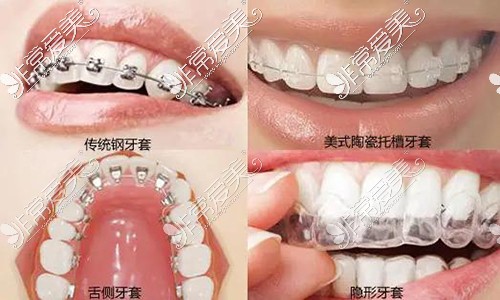 各种牙齿矫正方法