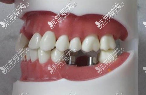 种植牙修复