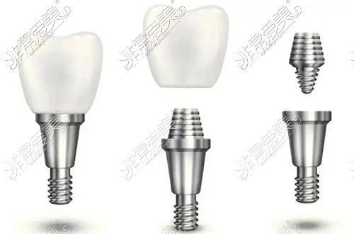 种植牙示意图