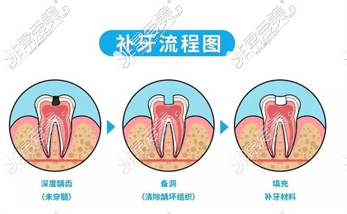 补牙流程图