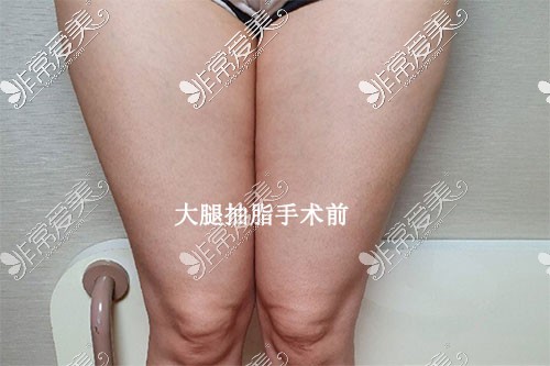 韩国365mc医院大腿抽脂手术前图