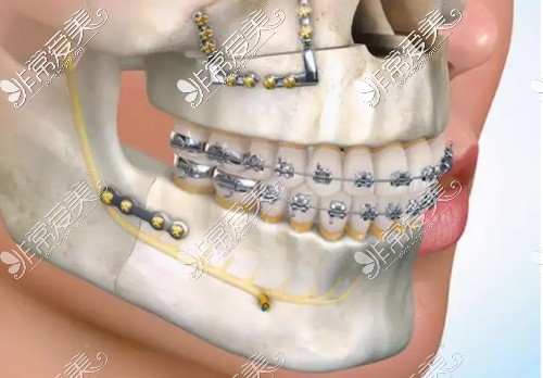 双颚矫正联合牙齿矫正过程