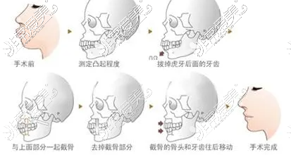 双颚手术过程图解