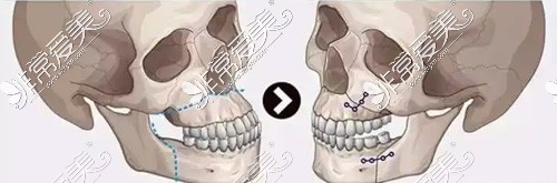 双颚手术固定方式图