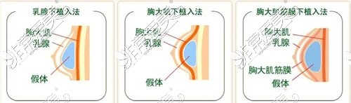 假體隆胸植入方式