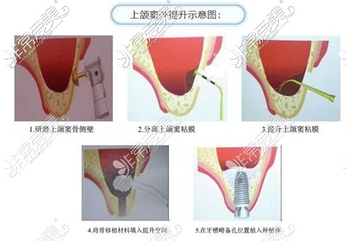 重庆即刻种植牙怎么收费?价格贵吗?大概要多少钱?附表!