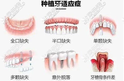 種植牙適應(yīng)癥