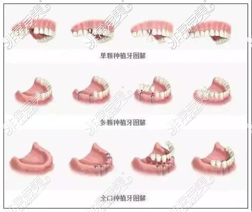 不同颗数种植牙图解