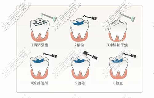 窝沟封闭示意图