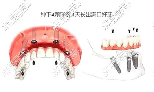 allon-4种植牙示意图