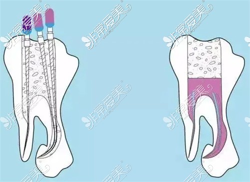 根管治疗示意图