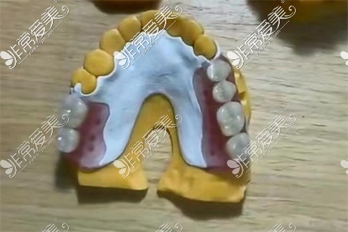 牙支架的种类图片