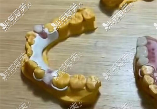 牙支架的种类图片