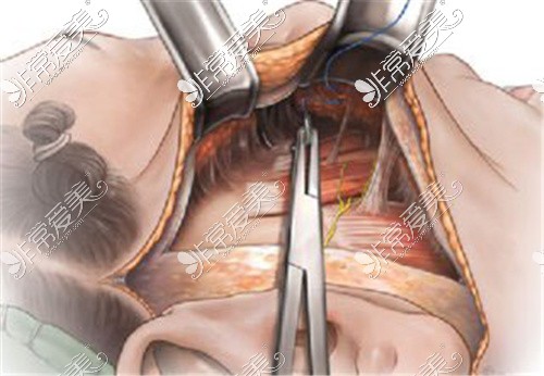面部提升进行韧带剥离
