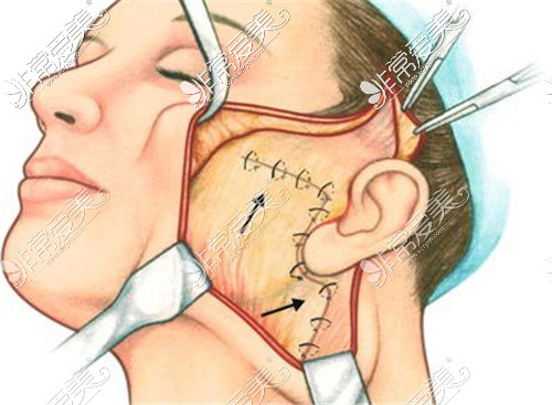 面部提升手术内部韧带折叠固定