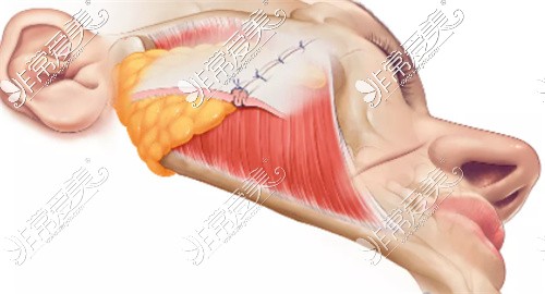 面部拉皮提升手术韧带固定折叠