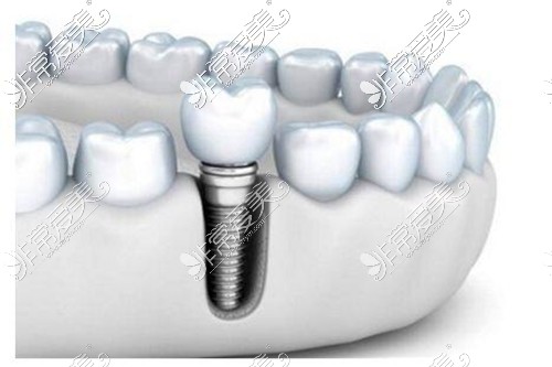 种植牙示意图