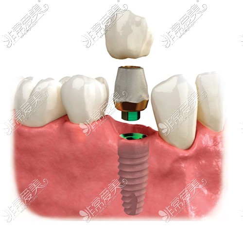 种植牙示意图