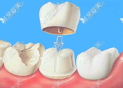 烏魯木齊牙齒美白示意圖