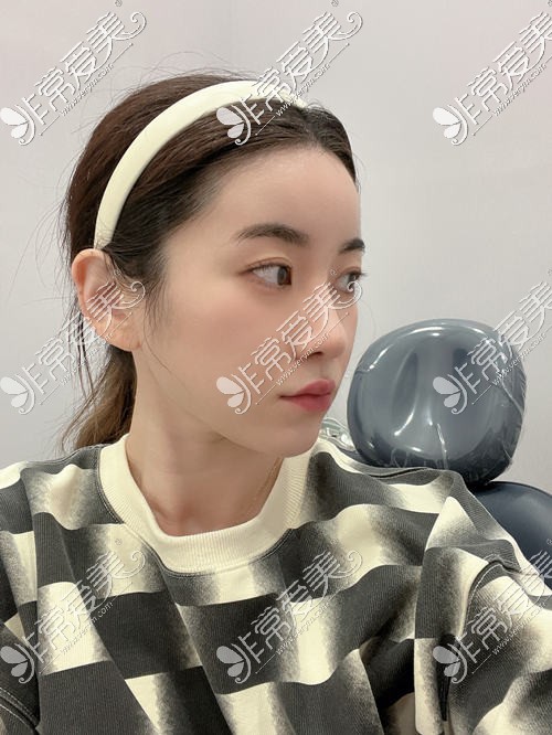 韩国VG百利酷整形外科鼻综合修复手术术后