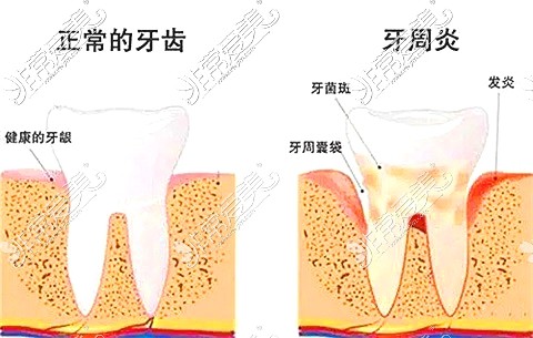 牙齒疾病對比圖