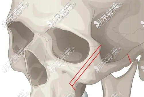 成都李运峰颧骨手术功课:价格/成效/风格/细节全方位解读!