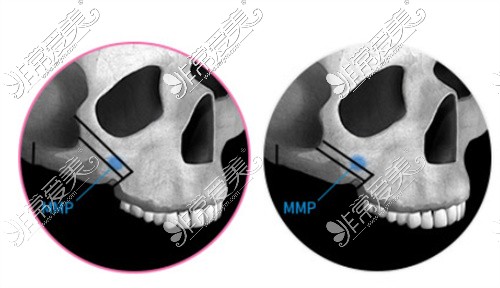 颧骨高点MMP点