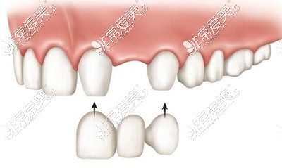 镶牙改善治疗展示图照片