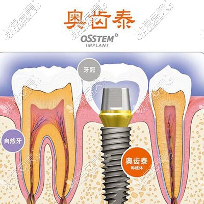 韩国奥齿泰种植牙展示图