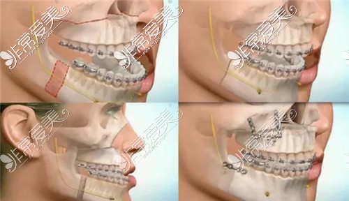 正颌手术过程图示