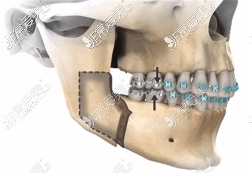 正颌手术展示图