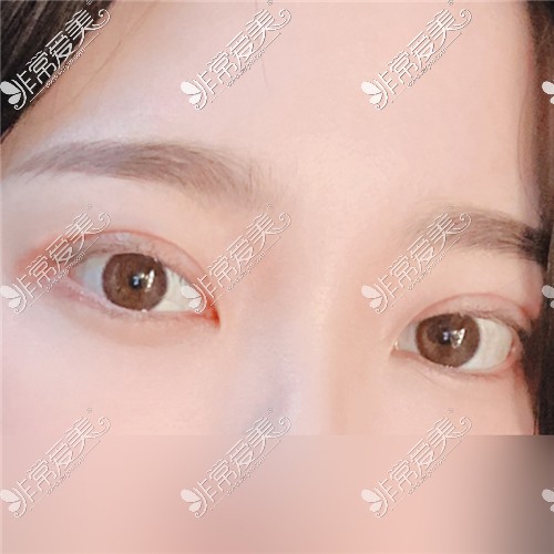 韩国yellow做埋线双眼皮手术术后图片