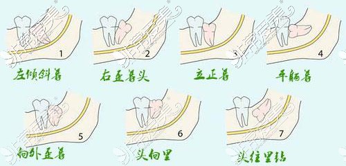 智齒阻生分類