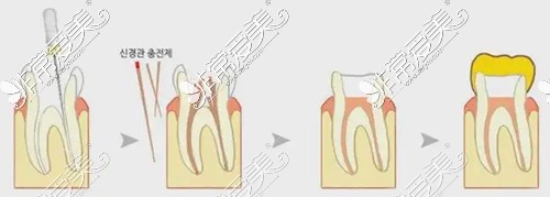 根管治疗过程