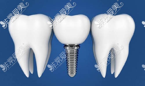 种植牙图片