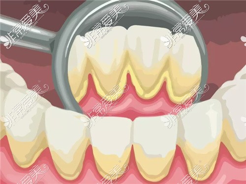 北京哪里洗牙便宜又好?这几家价格实惠种类还多很划算!