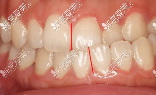 偏颌导致的牙齿畸形
