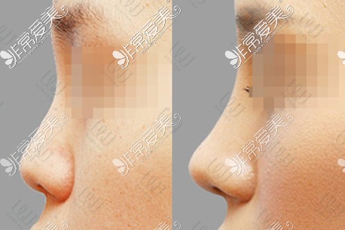 WJ原辰整形外科隆鼻院长团:带你了解你适合什么鼻型附案例!