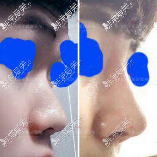 韩国现代美学整形医院男士鼻整形示例图