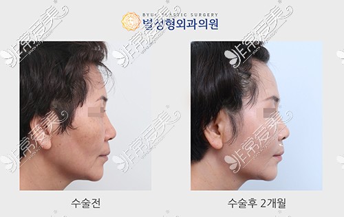 韩国星整形外科医院面部脂肪填充手术