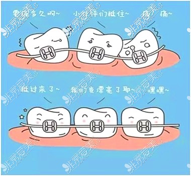 牙齒矯正示意圖