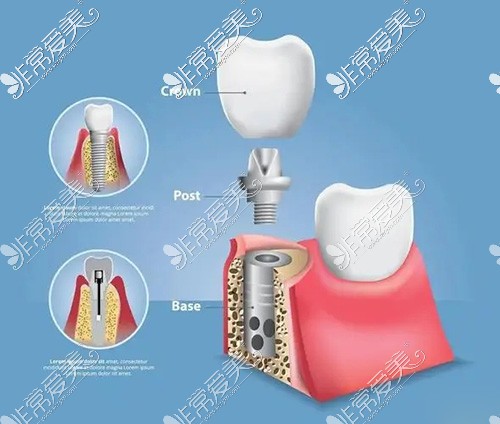 种植牙结构图示