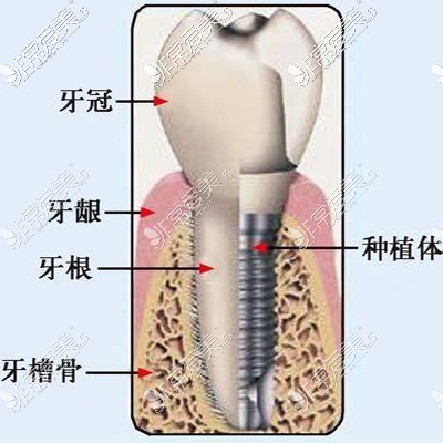 种植牙结构图示