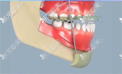 成人反颌的矫正方法有哪些？明确成人牙齿反颌都怎么矫正