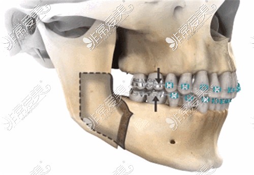 正颌手术演示图