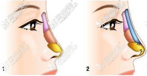 隆鼻示意图