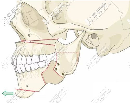 正颌手术展示图