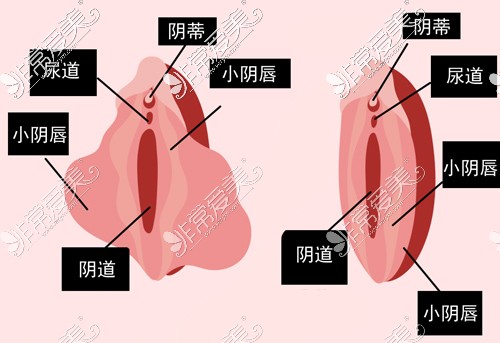 女性小阴唇整形前后对比