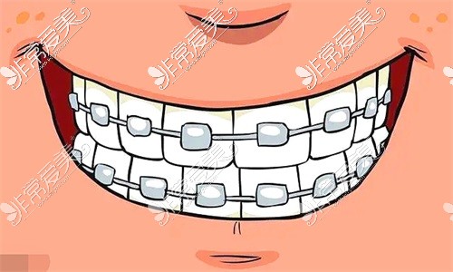 石河子奥丹德口腔牙齿矫正示意图